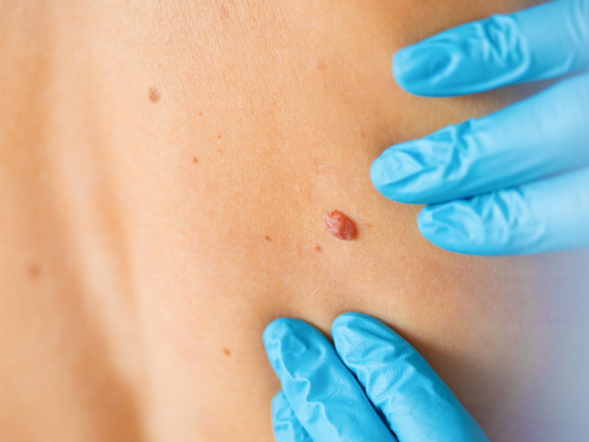 Ocena znamion na skórze – ważna profilaktyka i diagnostyka nowotworów skóry