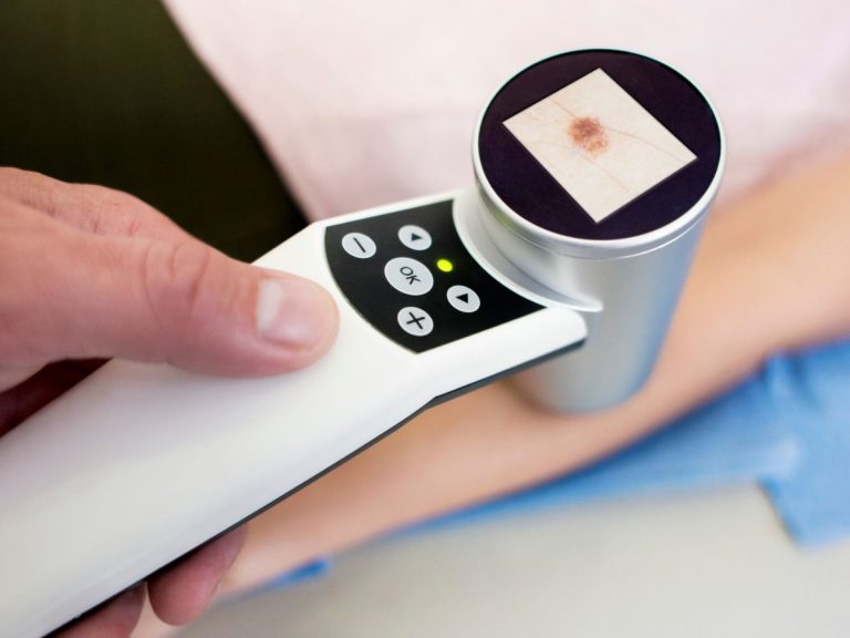 Wideodermatoskopia – co to jest?