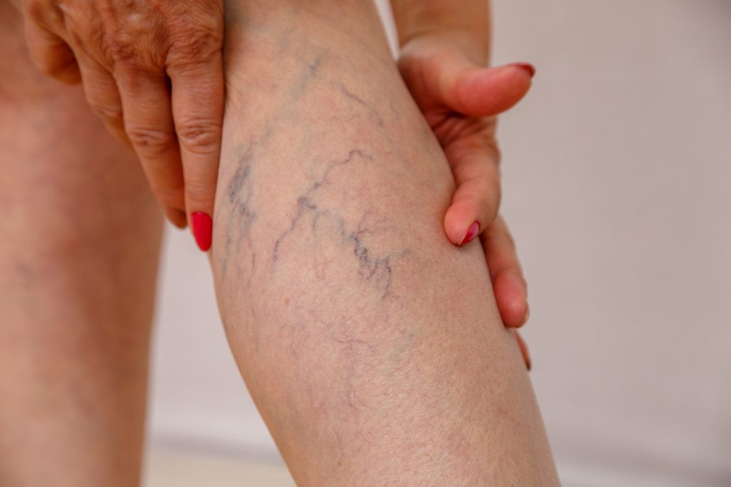 Skleroterapia piankowanie żylaków